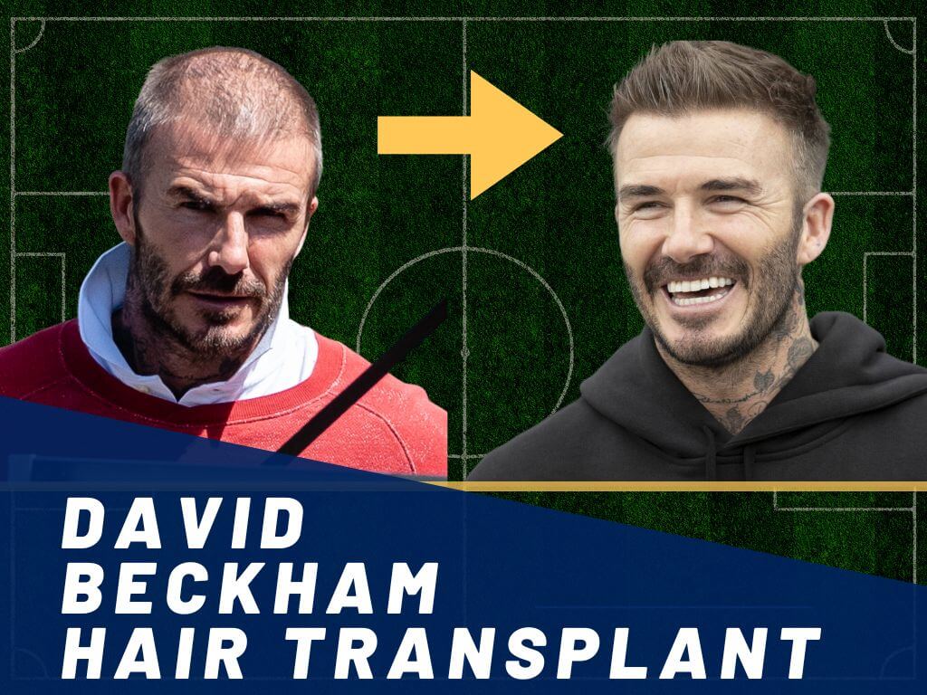 David Beckham Bald